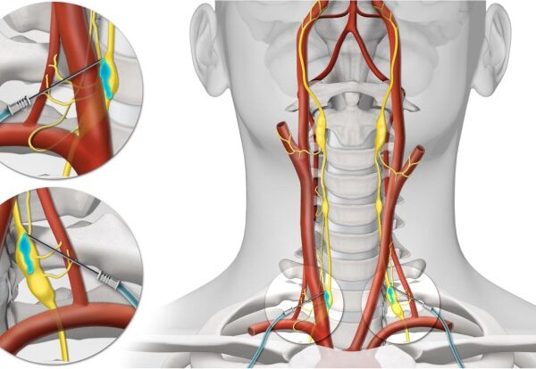 Stellate Ganglion Block