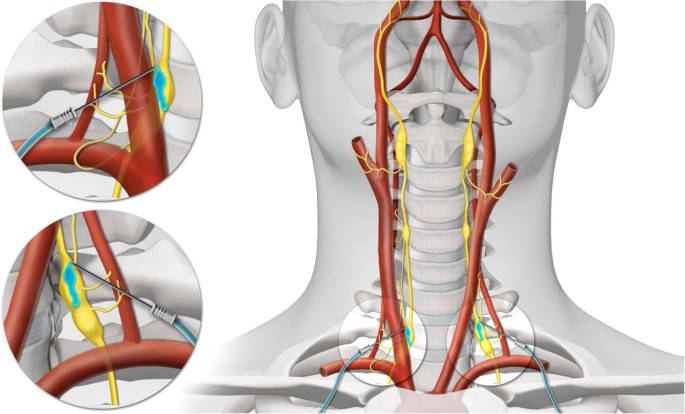Stellate Ganglion Block
